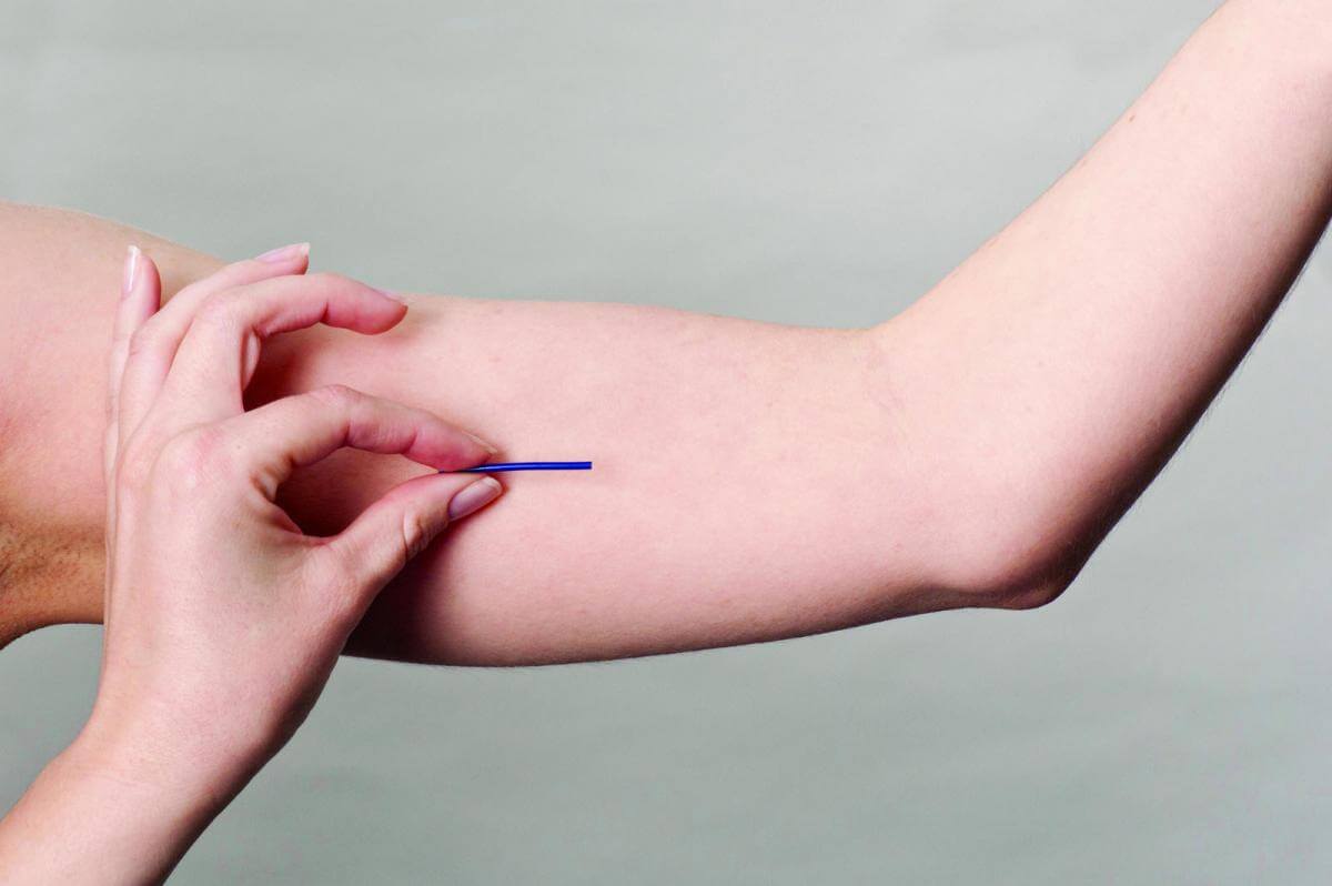 Implanon: Até 3 anos de eficácia contraceptiva